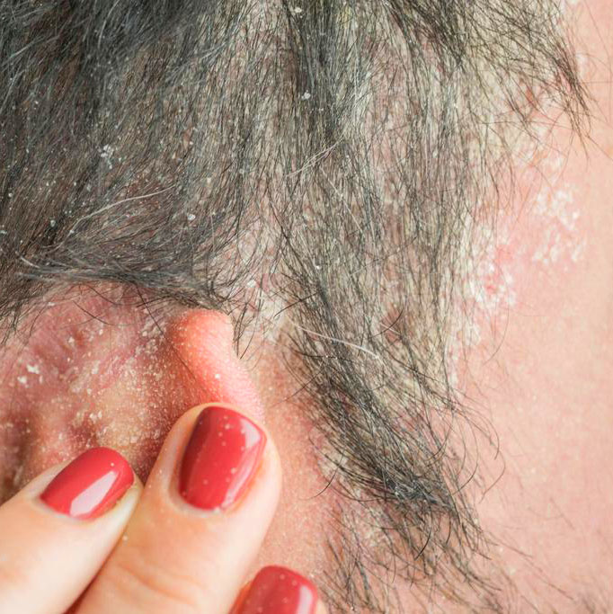 Come risolvere il problema della forfora, seborrea, capelli grassi e inestetismi